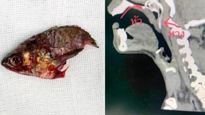 Peixe pula direto para a boca de pescador e acaba preso entre a garganta e a cavidade nasal