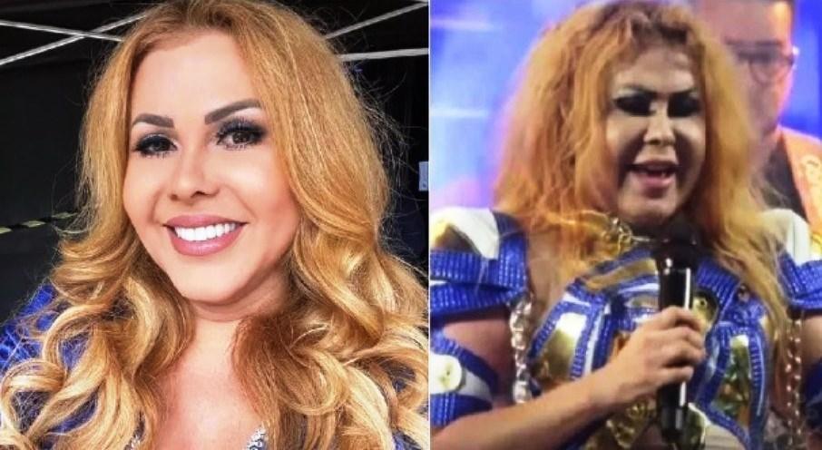 Entenda o que pode ter causado o inchaço no rosto da cantora Joelma