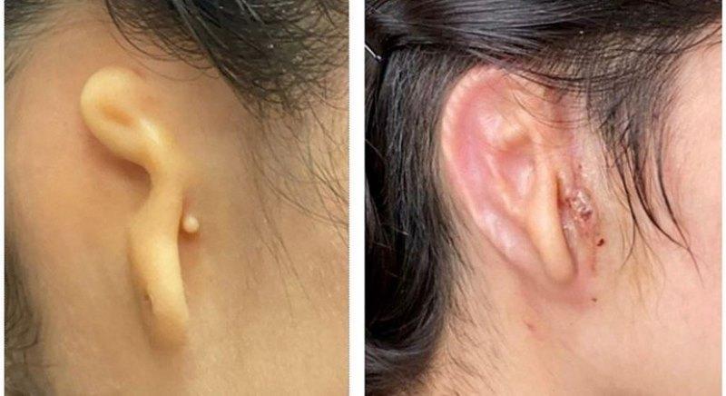 Médicos implantam em paciente orelha feita em impressora 3D usando células humanas