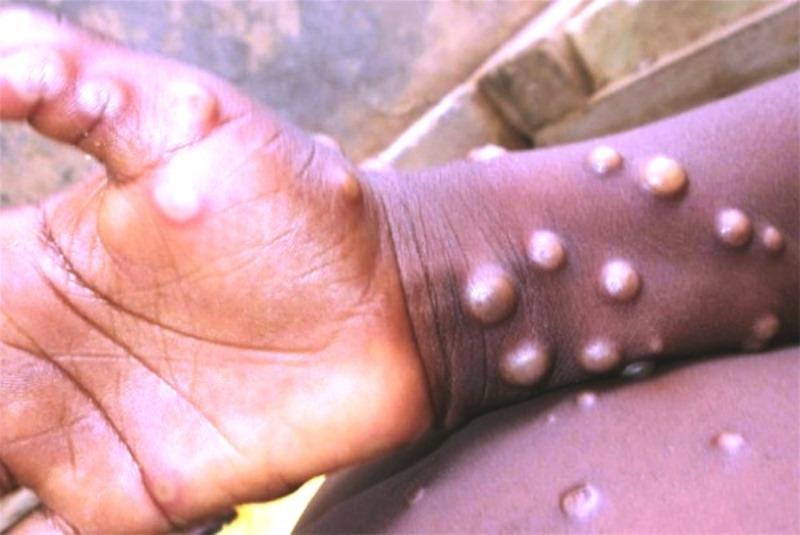 Brasil já tem oito casos confirmados de varíola dos macacos: Veja dicas de como se prevenir da doença