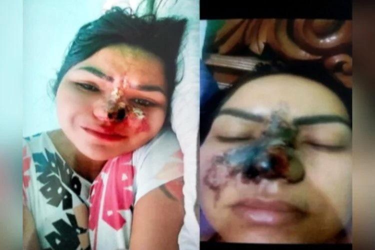 Polícia Civil apura caso de mulher que perdeu parte do nariz em cirurgia estética feita por dentista