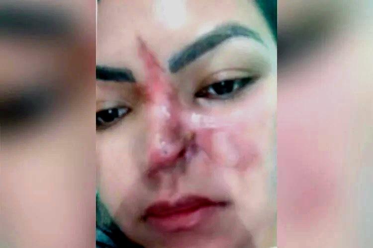 Polícia Civil apura caso de mulher que perdeu parte do nariz em cirurgia estética feita por dentista