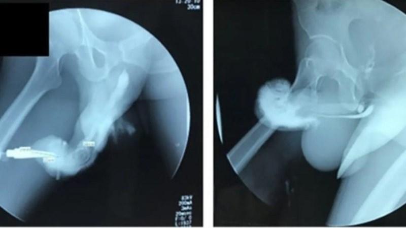 Homem quebra o pênis e é diagnosticado com ‘deformidade berinjela’