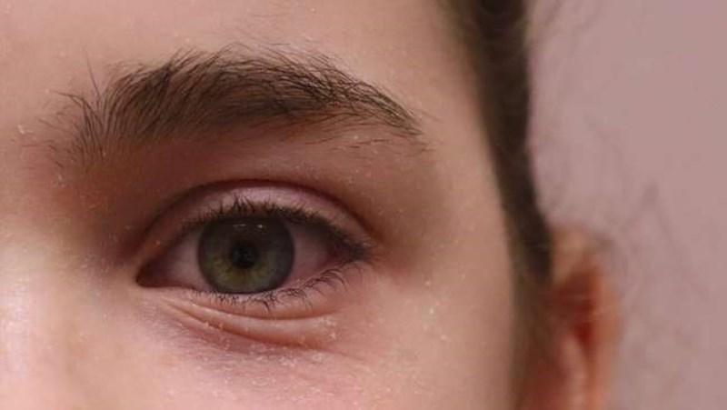 Sintomas de rinite vão além dos espirros: Aprenda a identificar o problema