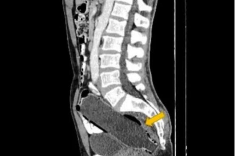 Médicos encontram garrafa de água de 250ml introduzida no reto de iraniano