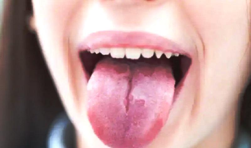 3 doenças infantis mais comuns que causam alterações na língua; fique atento aos sinais