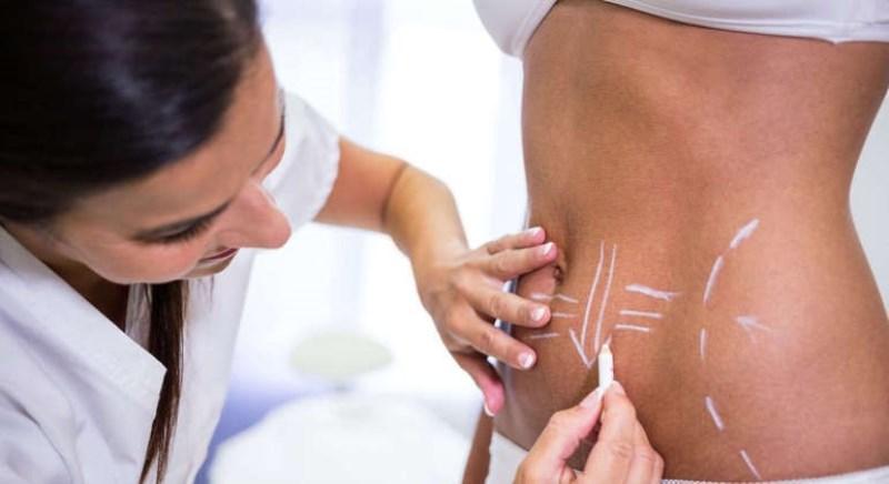Lipoaspiração e abdominoplastia não são tratamentos para perder peso, alerta especialista