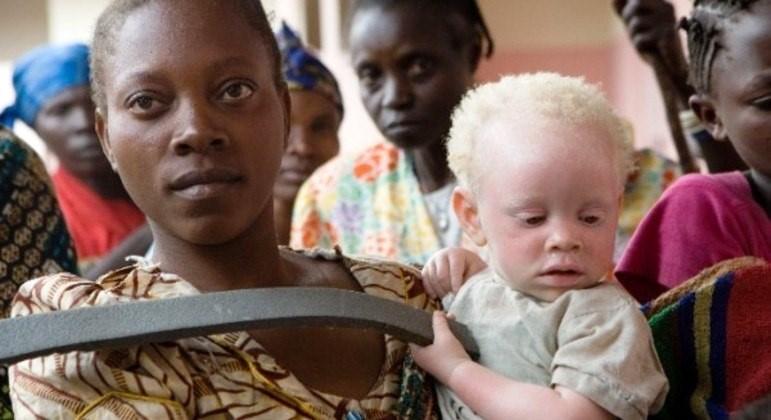 Pai é preso por tentar vender os três filhos albinos que seriam usados em práticas de feitiçaria