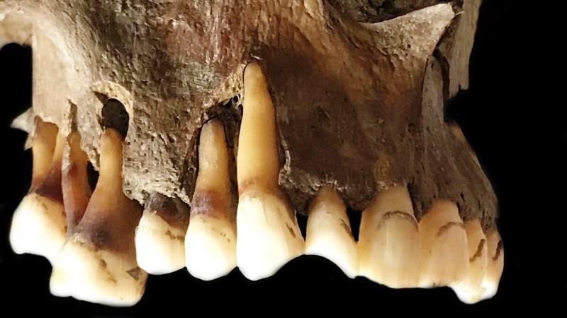 Variantes modernas da herpes têm ligação com beijos da Idade do Bronze