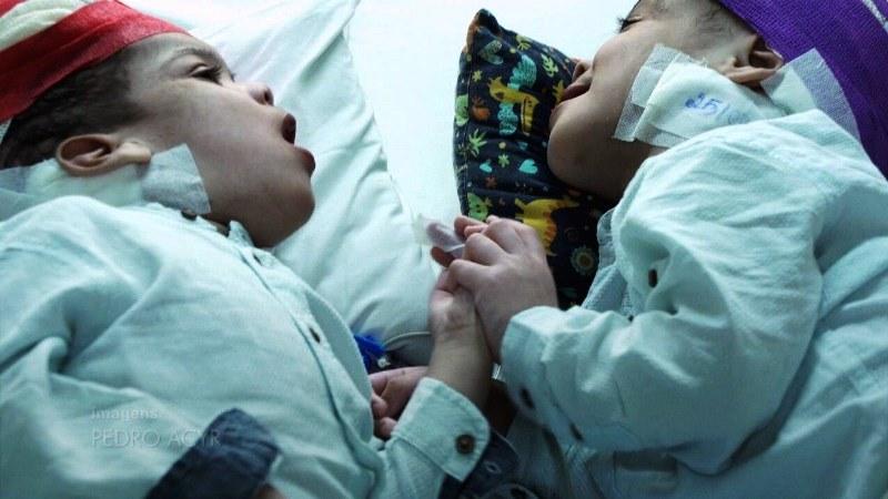 Gêmeos unidos pelo crânio são separados após nove cirurgias; equipe médica brasileira se torna referência