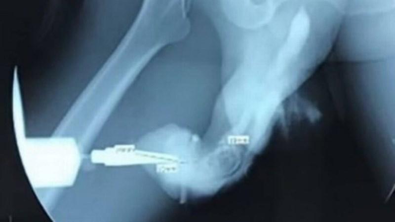 Homem de 50 anos sofre fratura no pênis durante ‘sexo mais vigoroso’