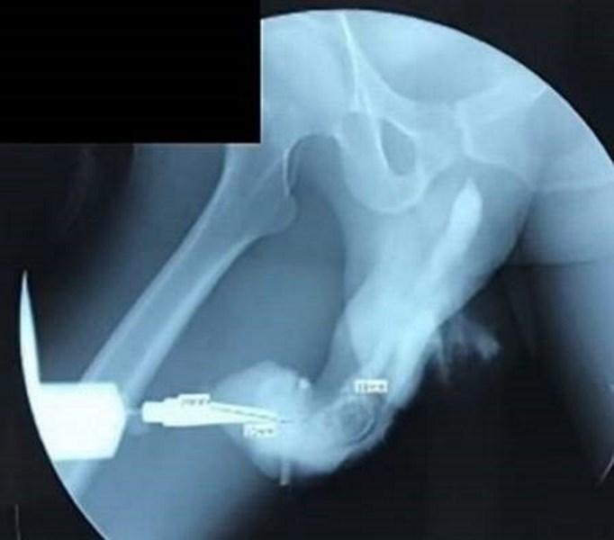 Homem de 50 anos sofre fratura no pênis durante ‘sexo mais vigoroso’