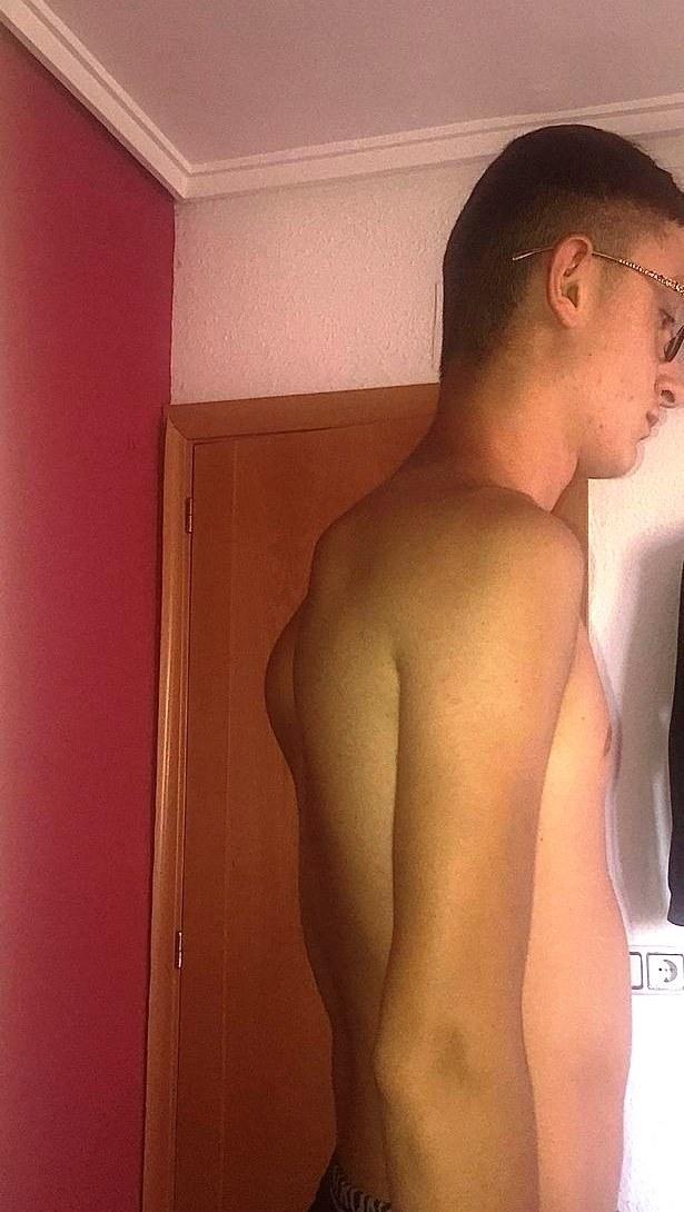 Jovem com condição rara tem ossos crescendo ‘fora do esqueleto’