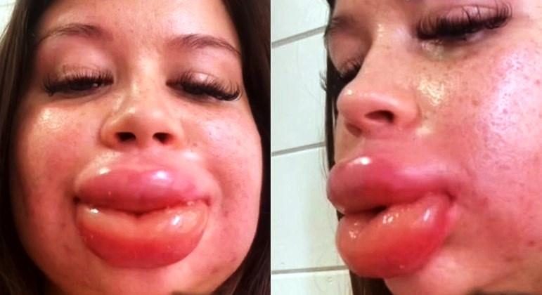 Lábios de jovem dobram de tamanho após preenchimento dar errado