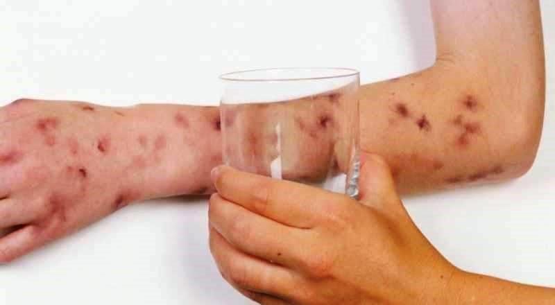 ES já registrou 41 mortes por meningite só este ano; baixa cobertura vacinal preocupa