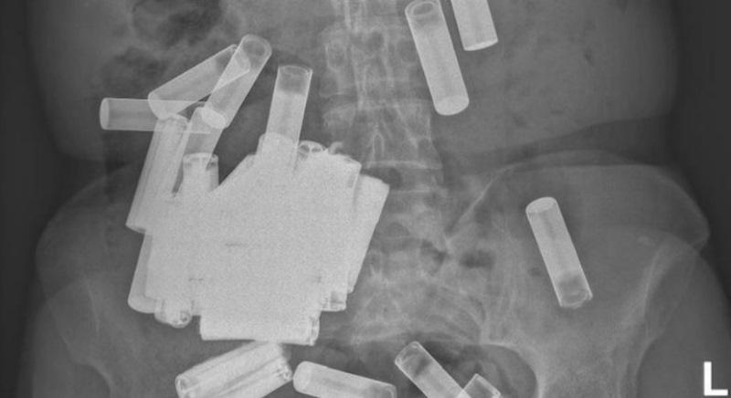Mulher com 55 pilhas dentro do corpo deixa médicos chocados