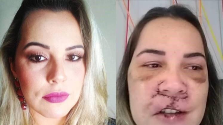 “Corroeu as células”, revela influenciadora que teve rosto deformado