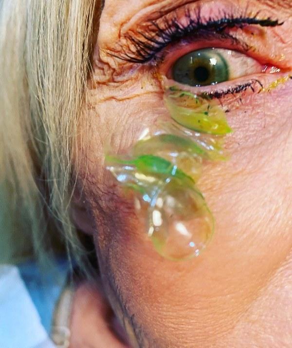 Oftamologista remove 23 lentes de contato perdidas em olho de paciente