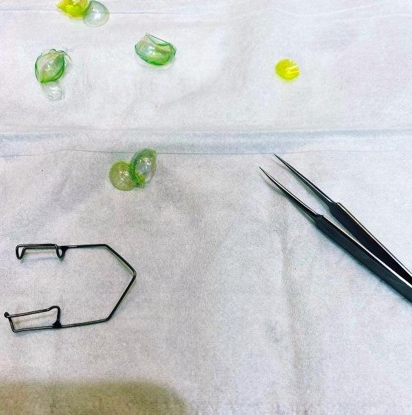 Oftamologista remove 23 lentes de contato perdidas em olho de paciente