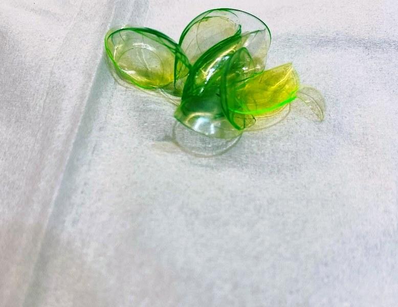 Oftamologista remove 23 lentes de contato perdidas em olho de paciente
