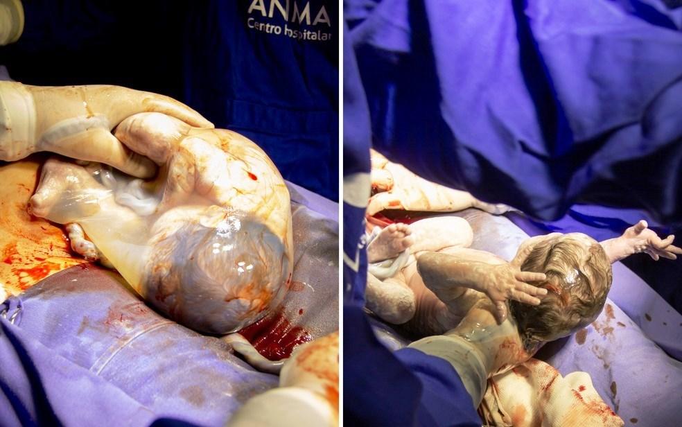 Mãe se surpreende ao ver que deu à luz gêmea empelicada em hospital de Anápolis