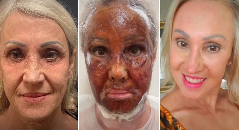 Peeling bizarro que viralizou na web promete rejuvenescer a pele em até 20 anos; saiba os riscos