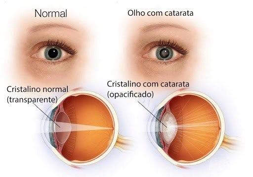 Catarata pode levar à cegueira se não tratada