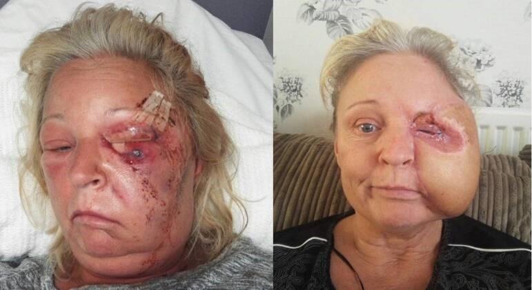 Mulher perde metade do rosto após ser infectada por bactérias devoradoras de carne