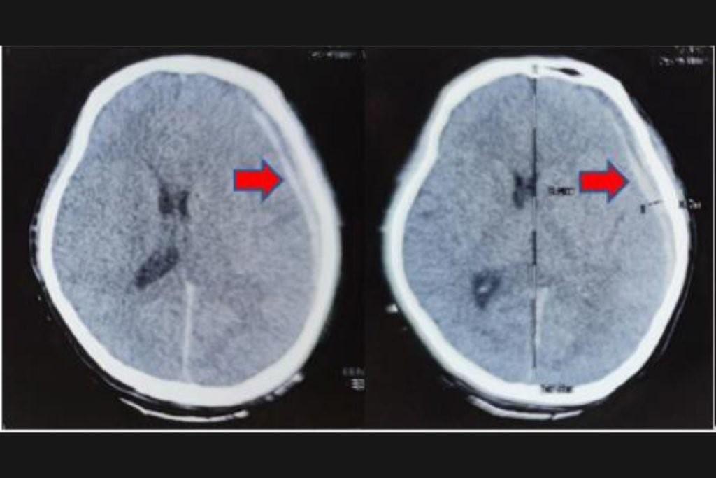 Aneurisma rompe durante o sexo e homem é internado com lesão cerebral