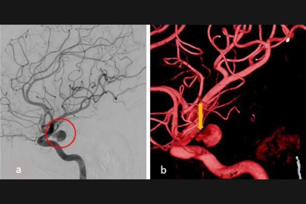 Aneurisma rompe durante o sexo e homem é internado com lesão cerebral
