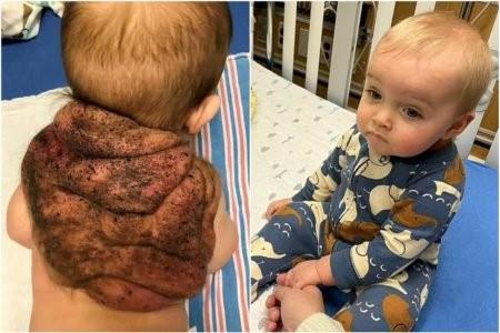 “Pequena tartaruga ninja”: menino ganha apelido dos pais ao nascer com casca nas costas