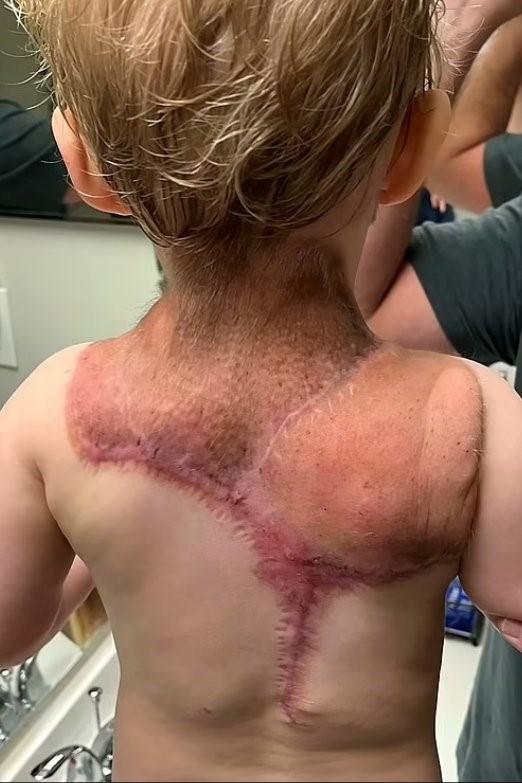 “Pequena tartaruga ninja”: menino ganha apelido dos pais ao nascer com casca nas costas