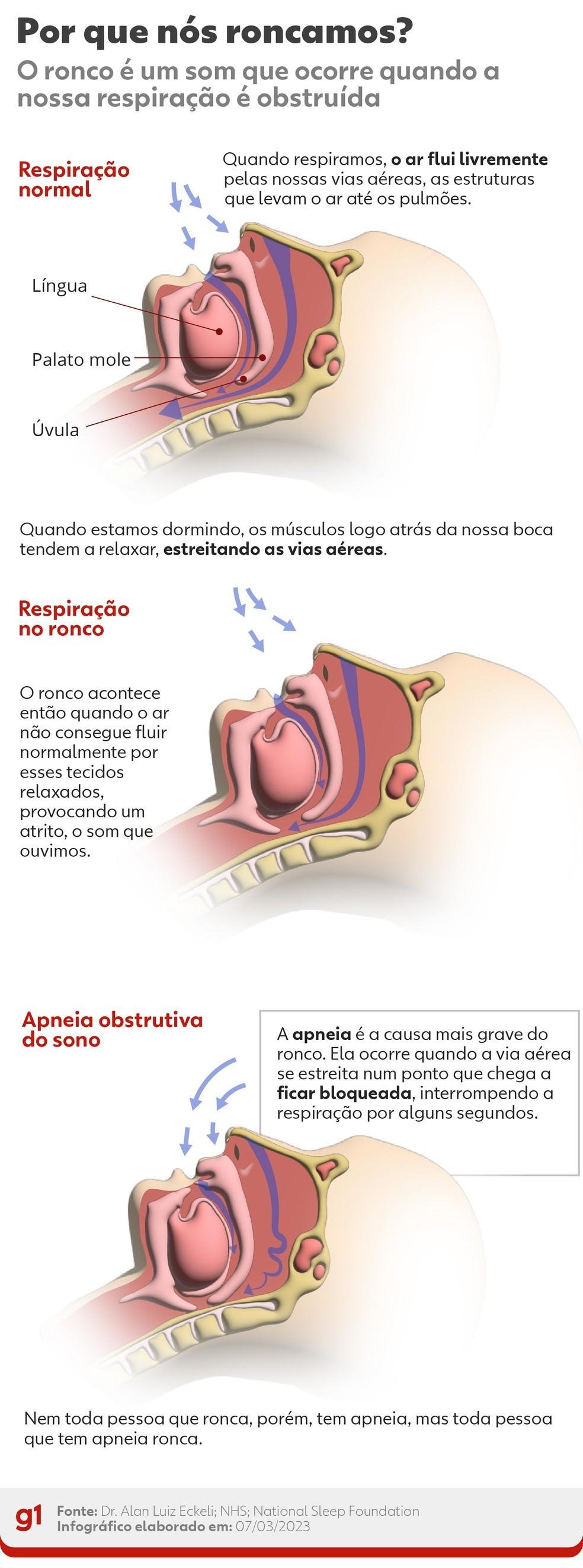 Roncar é normal ou faz mal? Pode indicar algo grave? Como sei se eu ronco? Veja 10 respostas