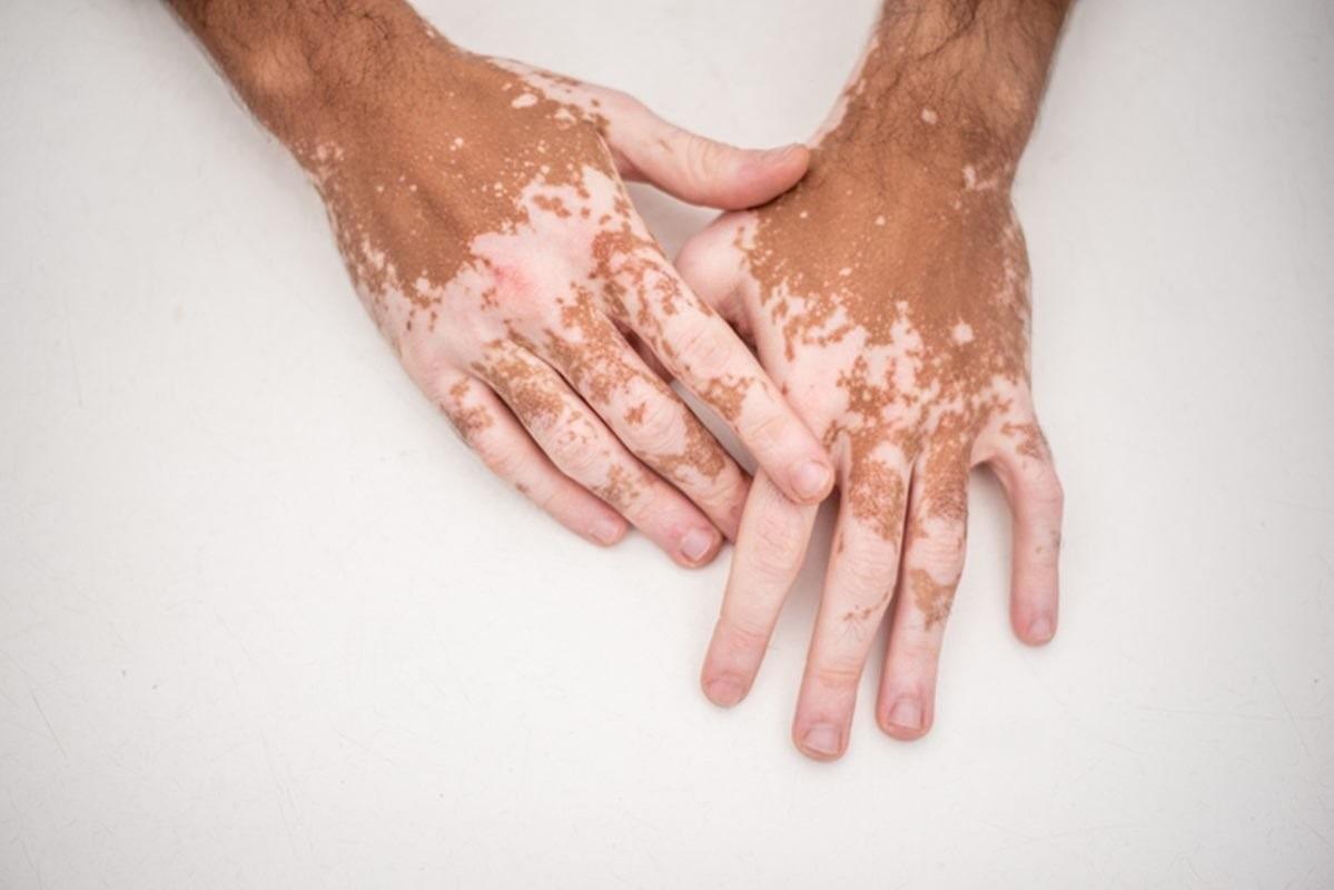Vitiligo: conheça os sintomas, tratamento e impacto da doença