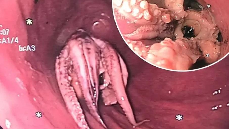 Médicos encontram polvo na garganta de paciente