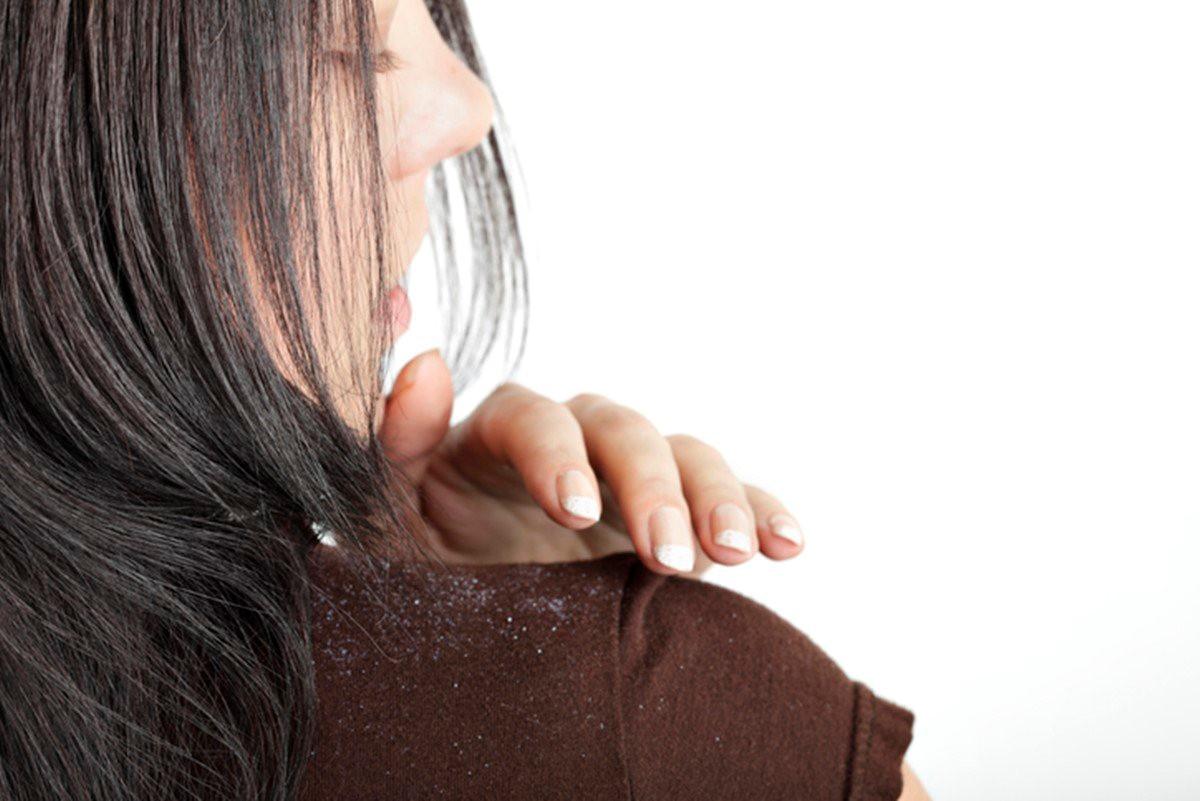 Caspa aumenta no frio? Dermatologista explica como tratar condição