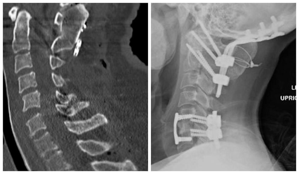 É possível sofrer decapitação e ainda sobreviver? Entenda os casos de disjunção craniocervical