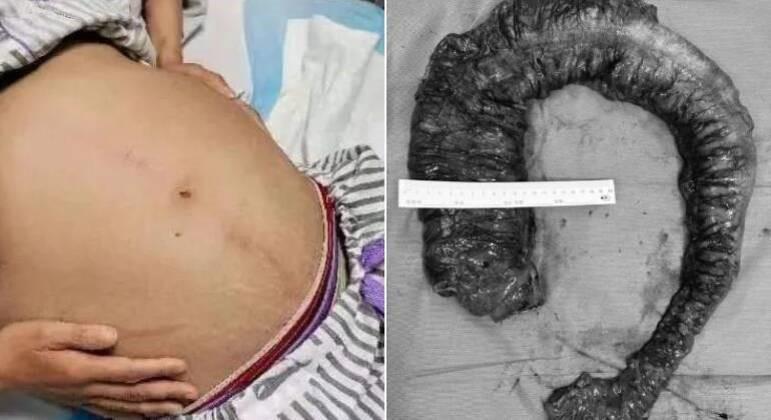 Cocô com 20 kg e quase 1 m de comprimento é retirado de intestino de mulher