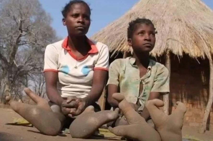 Tribo africana chama atenção por mutação genética que deforma os pés
