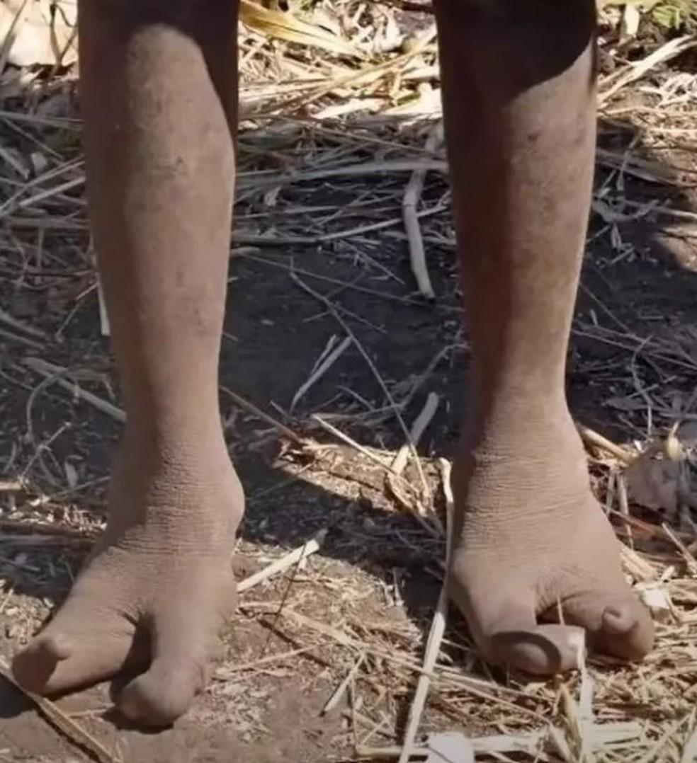 Tribo africana chama atenção por mutação genética que deforma os pés
