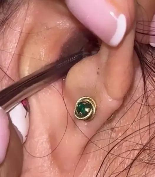 Barata viva é removida de ouvido de mulher e momento viraliza