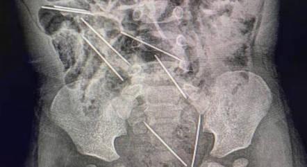 Menino de 2 anos engole 8 agulhas e passa por cirurgia