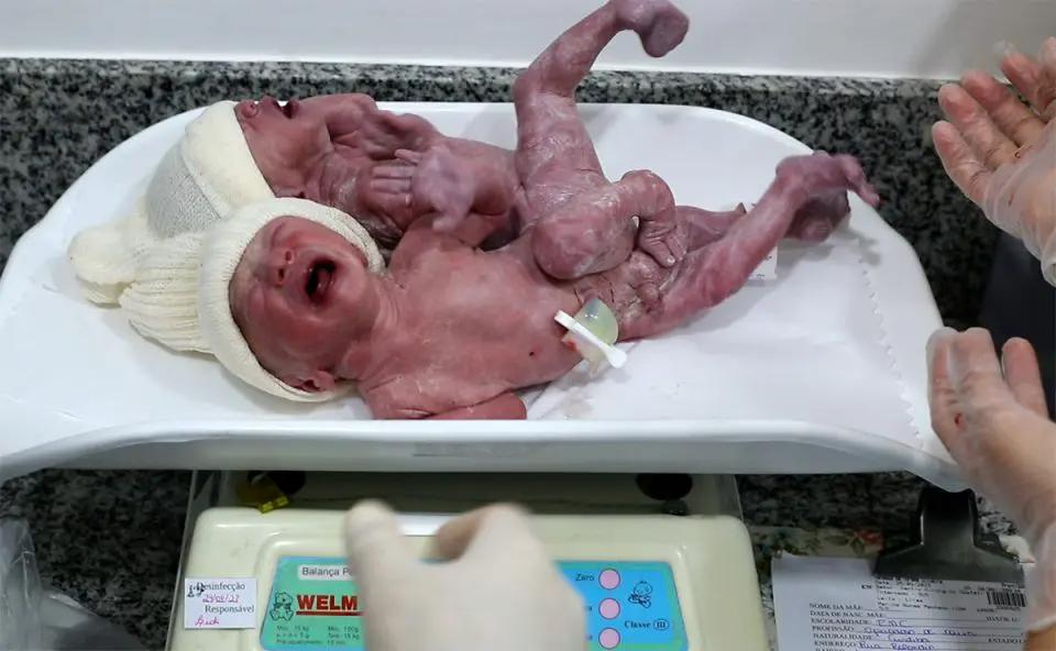 Gêmeos siameses nascem unidos pelo sacro; médica revela que caso é ainda mais raro