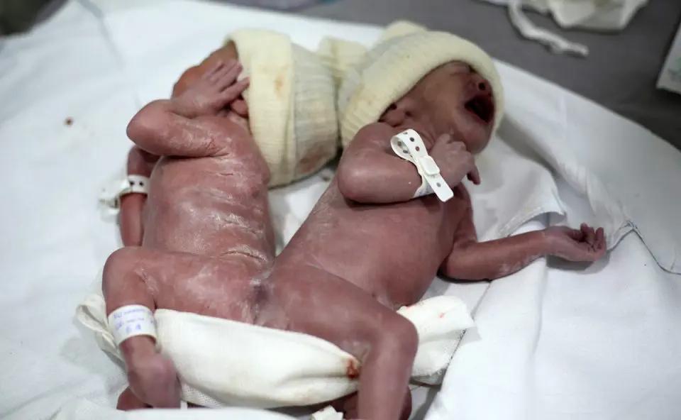 Gêmeos siameses nascem unidos pelo sacro; médica revela que caso é ainda mais raro