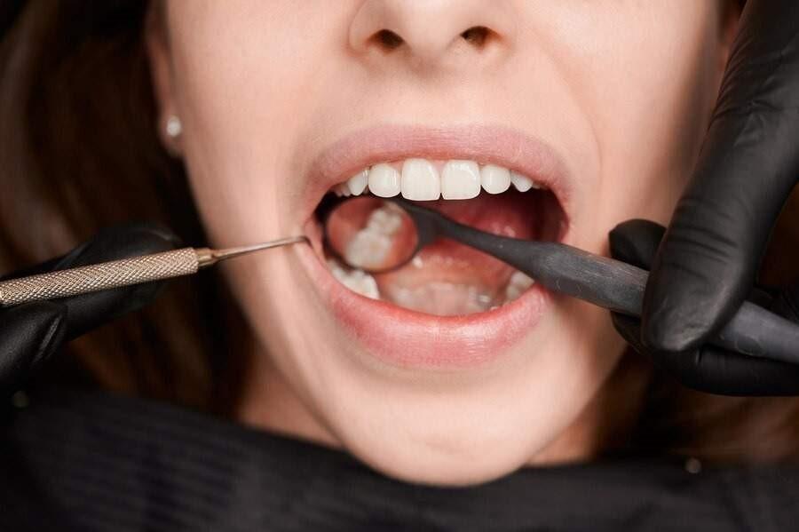 É necessário tirar o siso? Entenda para que serve o “dente do juízo”