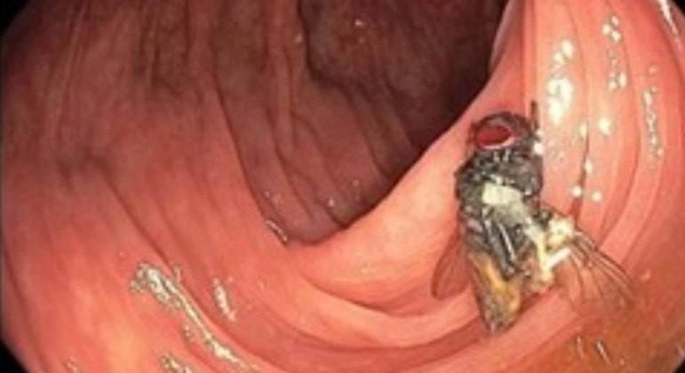 Médicos descobrem mosca viva e intacta dentro do intestino de idoso