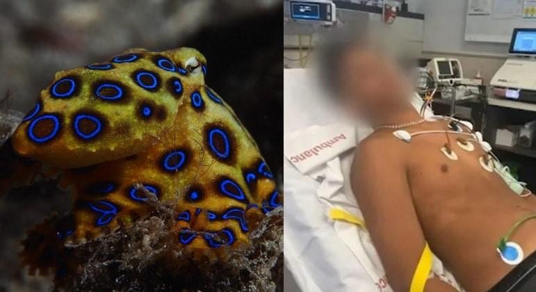 Jovem quase morre ao pegar concha que era esconderijo de polvo extremamente letal