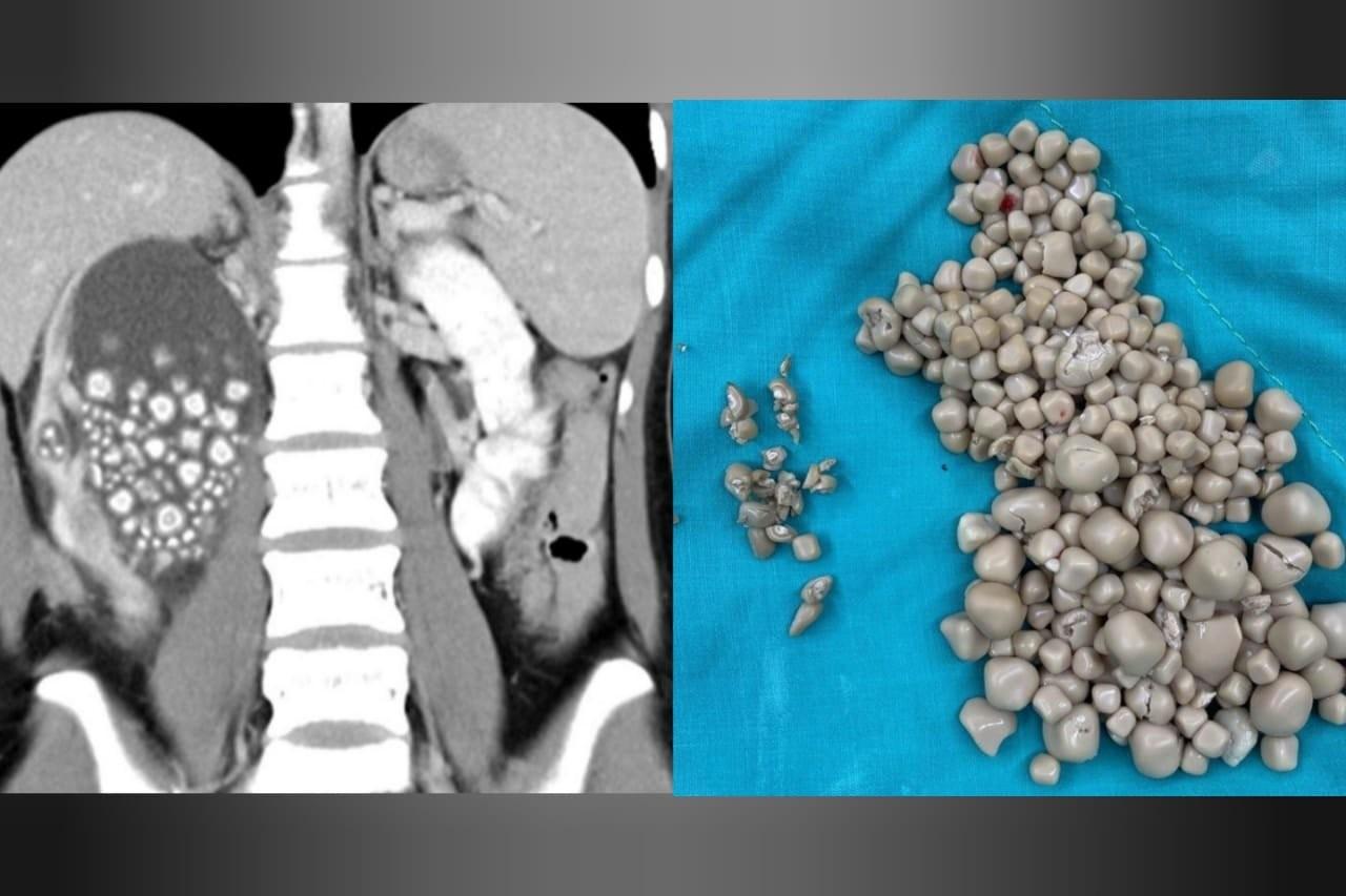 Médicos retiram 300 pedras do rim de taiwanesa que não tomava água