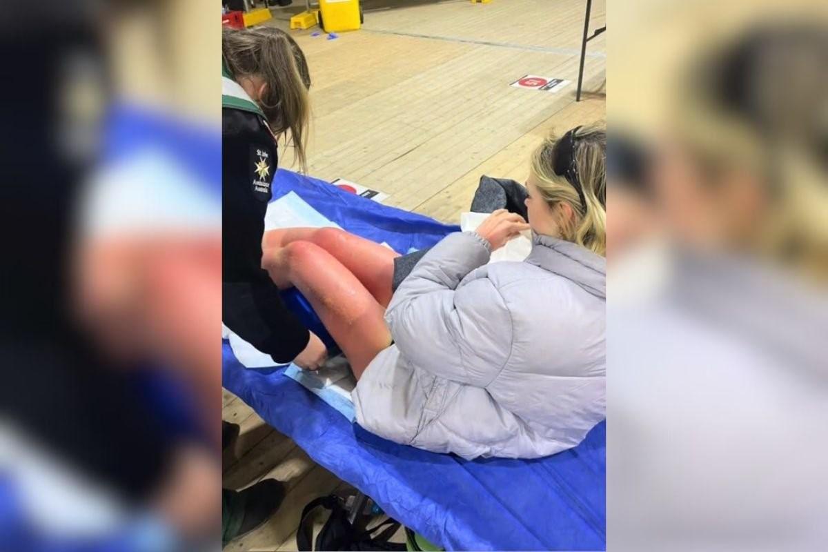 Jovem se expõe ao sol, tem alucinações e fica coberta de bolhas