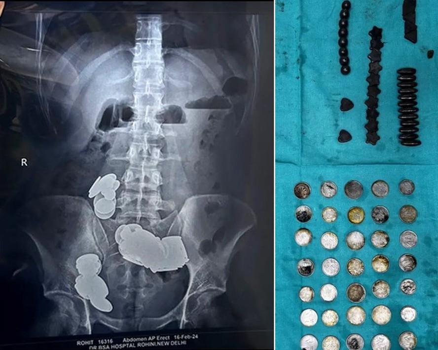 Jovem é operado após engolir 39 moedas e 37 ímãs alegando que 'zinco ajuda na musculação'